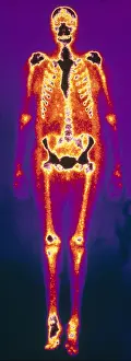 Medical Prints: Osteomyelitis