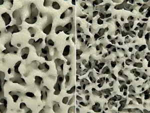 Density Prints: Osteoporosis, healthy (leftI) and osteoporotic (right) bone tissue, Illustration