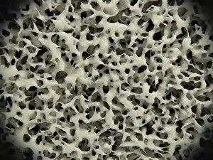 Density Prints: Osteoporosis, osteoporotic bone tissue, illustration