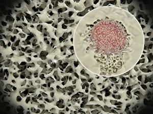 Density Prints: Osteoporosis: osteoporotic bone tissue. Osteoclast degrades bone tissue