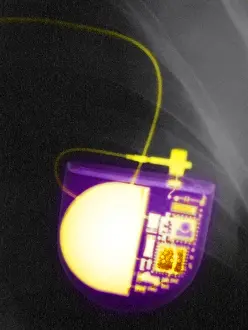 Technology Prints: Pacemaker