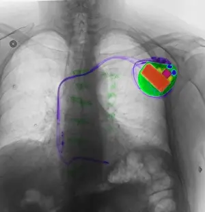 Device Prints: Pacemaker