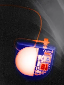 Technology Prints: Pacemaker