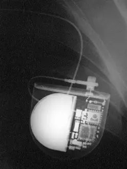 Technology Prints: Pacemaker