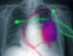 Maker Prints: Pacemaker Defibrillator