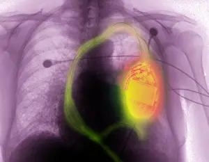 Maker Prints: Pacemaker Defibrillator