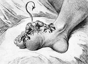 Demon Prints: The Pain of Gout, 1799