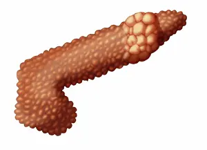 Pancreatic Prints: Pancreatic Cancer, Illustration