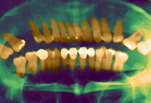 Technique Prints: Panoramic Dental X-Ray