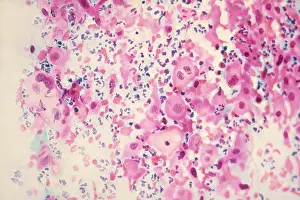 Pathological Prints: Pap Smear: Cancer under a microscope