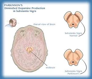 Neurological Prints: Parkinson's disease illustration shows diminished dopamine transmission in neurons