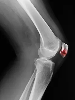 False Prints: Patellar Fracture X-Ray