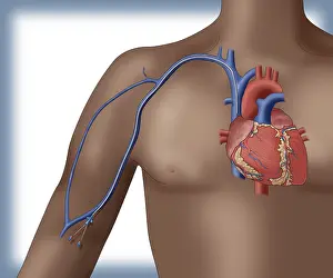 October Prints: PICC intravenous device, Illustration