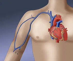 Device Prints: PICC intravenous device, Illustration