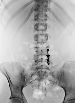 Diagnosis Prints: Pierced Navel, X-ray
