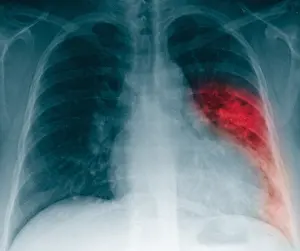 Pneumoniae Prints: Pneumonia, X Ray