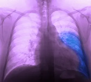 Pneumoniae Prints: Pneumonia, X Ray