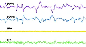 Wave Prints: Polygraph Tracings of REM Sleep
