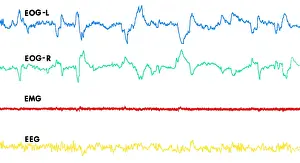 Wave Prints: Polygraph Tracings of REM Sleep