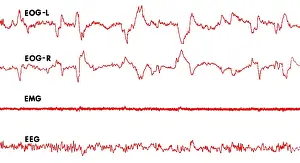 Wave Prints: Polygraph Tracings of REM Sleep