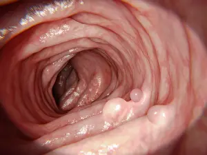 2018 Prints: Polyps in human intestine