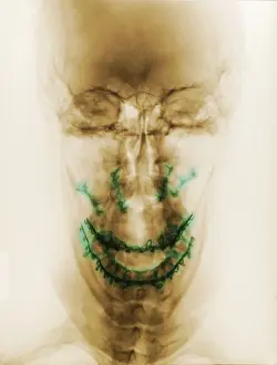 Patient Prints: Post Operative X-ray of Patient with Facial Fractures