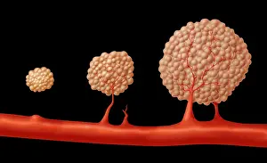 Malignancies Prints: Progression of Angiogenesis