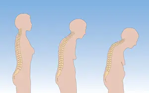 Spinal Prints: Progression of Osteoporosis