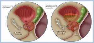 Internal Prints: Prostate Cancer, Illustration