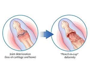 Condition Prints: Psoriatic Arthritis, Joint Damage Comparison, autoimmune disease, skin condition
