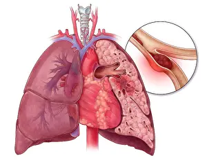 Clots Prints: Pulmonary Embolism, Illustration