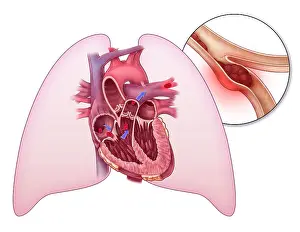 Chambers Prints: Pulmonary Embolism, Illustration