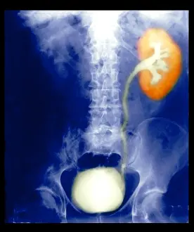 Collection Prints: Renal Colic