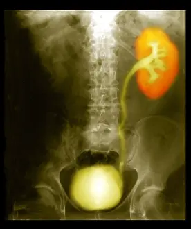 Collection Prints: Renal Colic