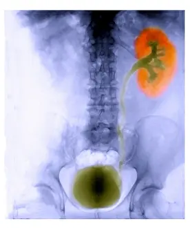Collection Prints: Renal Colic