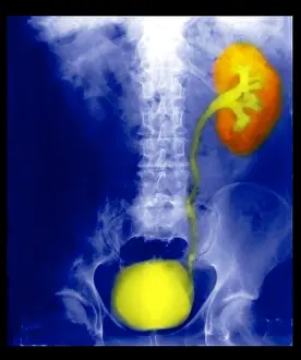 Collection Prints: Renal Colic