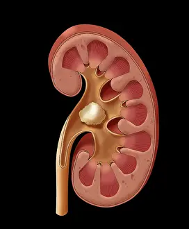Stone Prints: Renal Stones, Illustration