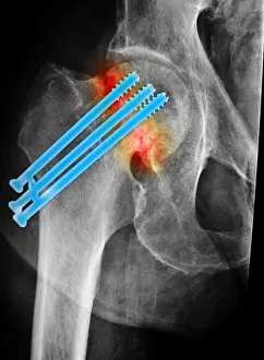 Surgery Prints: Repaired Hip Fracture
