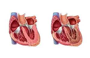 Cardiovascular Prints: Restrictive Cardiomyopathy