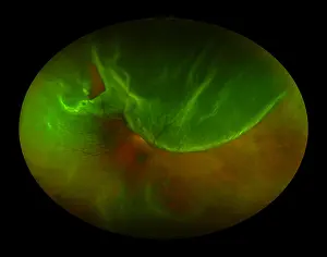 Prints of Detached retina : Retinal Detachment, Medical Scan of the Eye