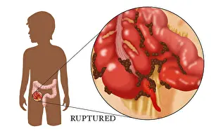 Intestines Prints: Ruptured Appendix