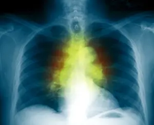 Nodes Prints: Sarcoidosis