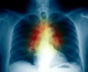 2004 Prints: Sarcoidosis