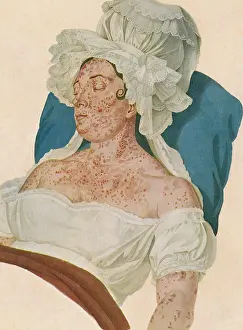 Fever Prints: Scarlet Fever
