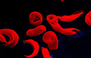 February Prints: SCD, Sickle-Cell Anemia Disease