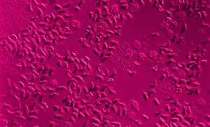 Cytopathology Prints: SCD, Sickle-Cell Anemia, light micrograph
