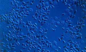 Cytopathology Prints: SCD, Sickle-Cell Anemia, light micrograph