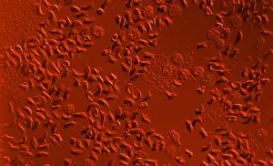 Optical Prints: SCD, Sickle-Cell Anemia, light micrograph