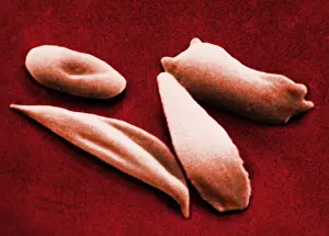 Cytopathology Prints: SCD, Sickle-Cell Anemia, under a microscope (SEM)