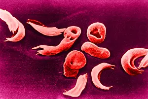 Cytopathology Prints: SCD, Sickle-Cell Anemia, under a microscope (SEM)